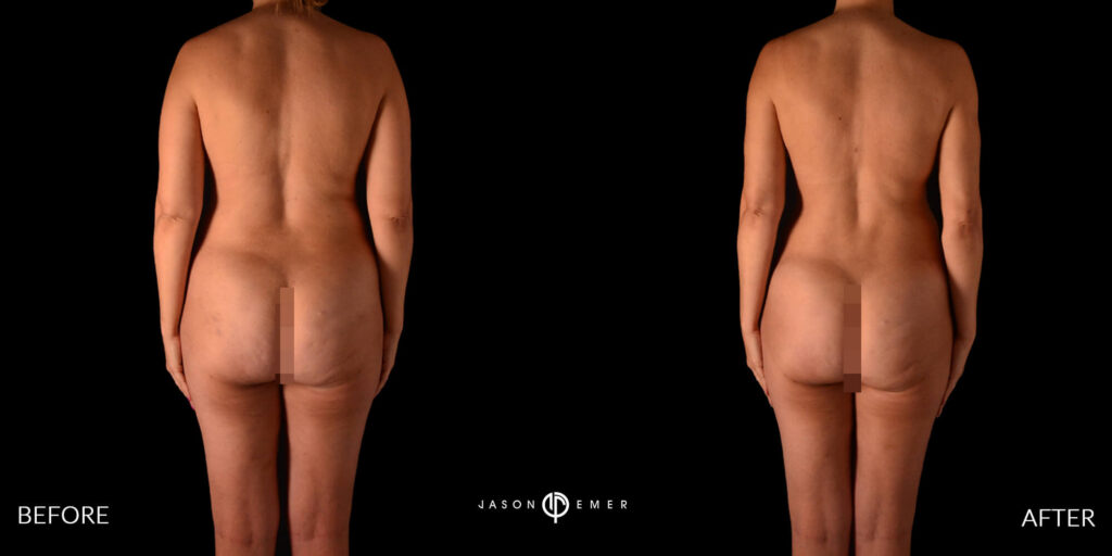 360 HD Lipo Before and After, Back