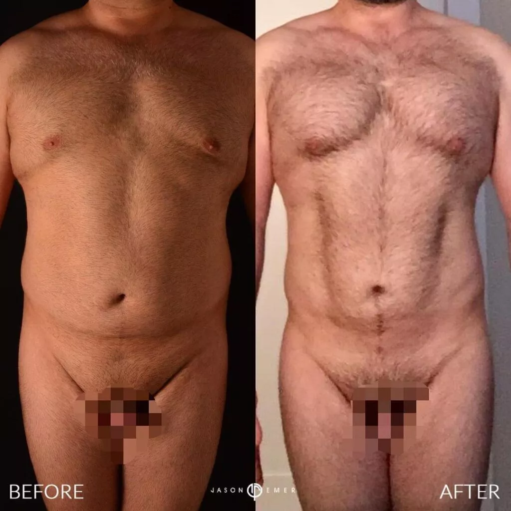 360-HD-Lipo-Beverly-Hills-Male-Patient-3-2-1024x1024-1
