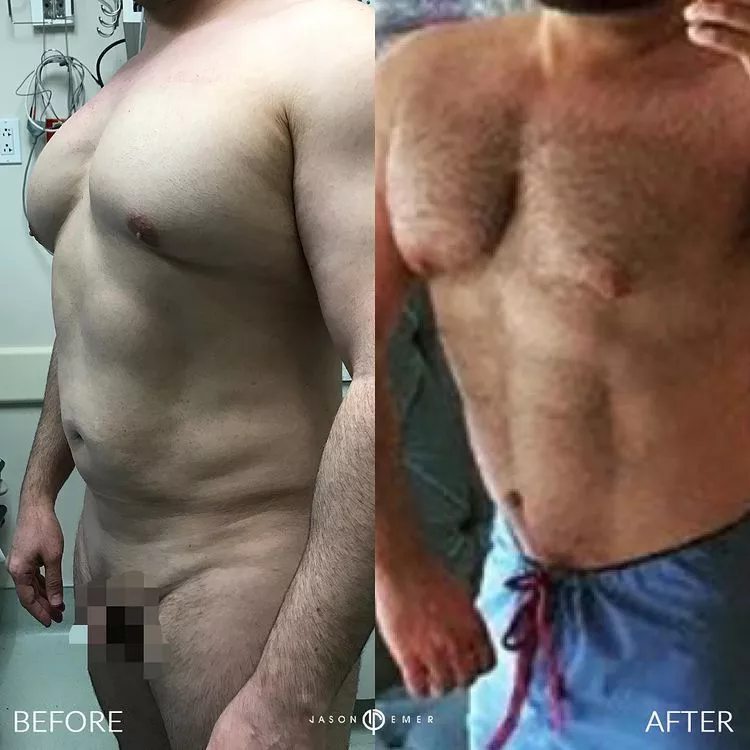360-HD-Lipo-Beverly-Hills-Male-Patient-3-3