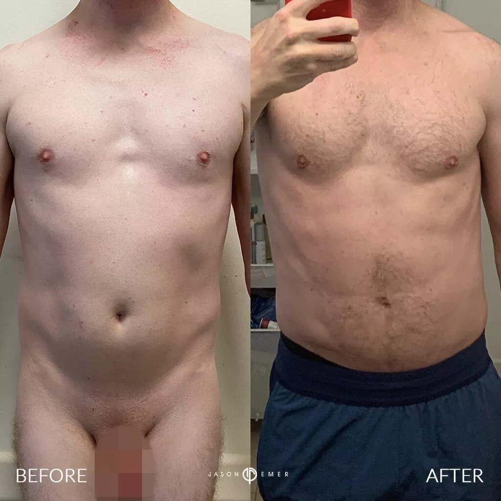 360-HD-Lipo-Beverly-Hills-Male-Patient-7-3-1024x1024-1
