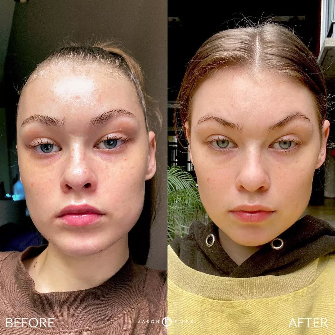 emerage-before-and-after-1-plasma-pen