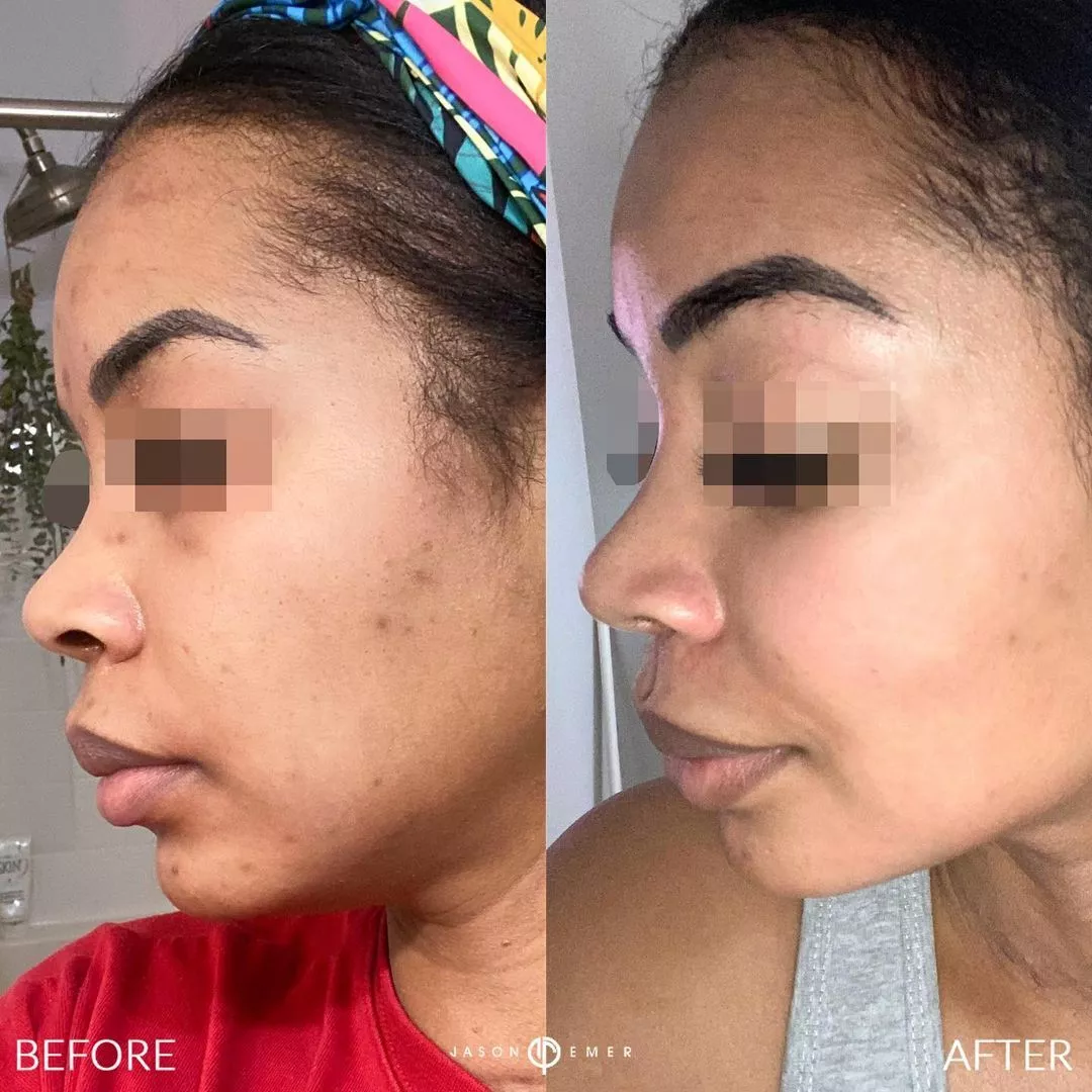 emerage-before-and-after-2-plasma-pen
