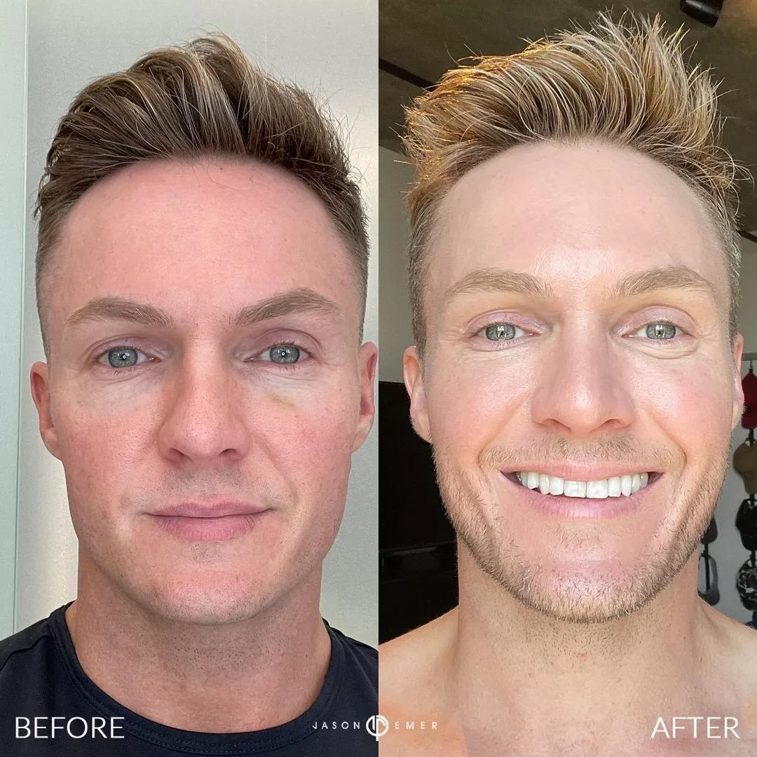 emerage-before-and-after-3-plasma-pen