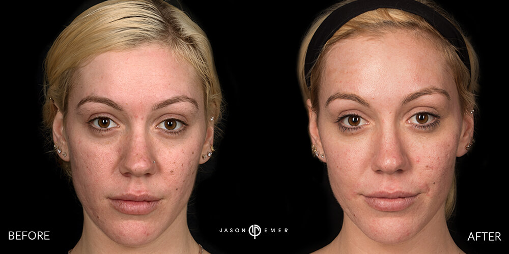 Acne-Scar-Laser-Treatment-Before-and-After-Female-Face